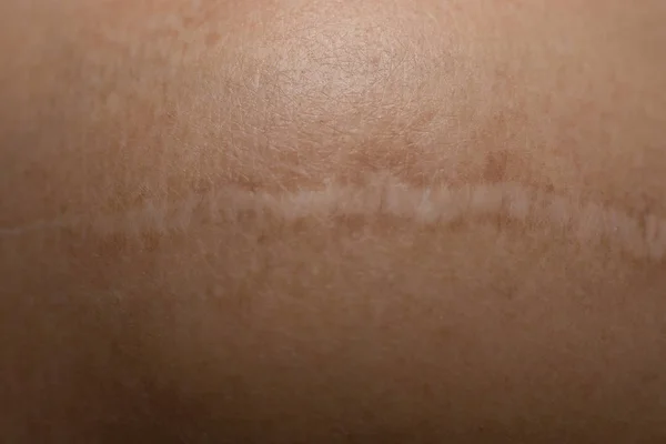 Un cheloide sulla pelle Immagine di primo piano del corpo — Foto Stock