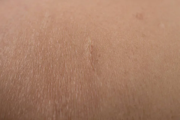 Ένα χηλοειδές σε δέρμα closeup εικόνα του σώματος — Φωτογραφία Αρχείου