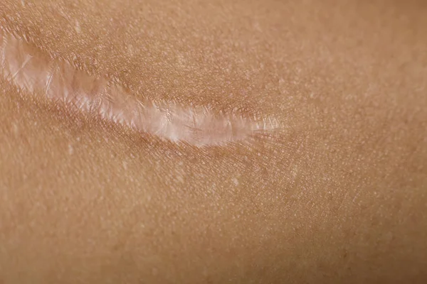 Um queloide na pele Imagem de close up do corpo — Fotografia de Stock