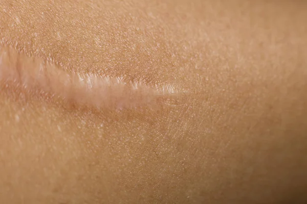 Un Keloïde sur la peau Image de gros plan du corps — Photo