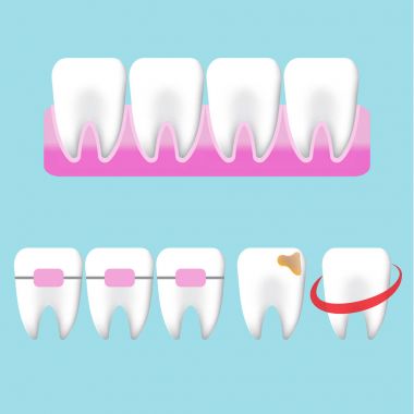 Beyazlatma diş karakter illüstrasyon mavi zemin üzerine.