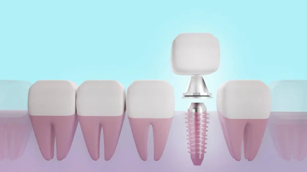 Imagem Renderização Implante Dentário Para Conteúdo Médico — Fotografia de Stock