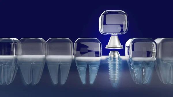 Зображення Імплантації Зубів Медичного Контенту — стокове фото
