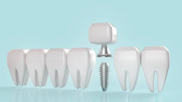 Imagem Renderização Implante Dentário Para Conteúdo Médico — Fotografia de Stock