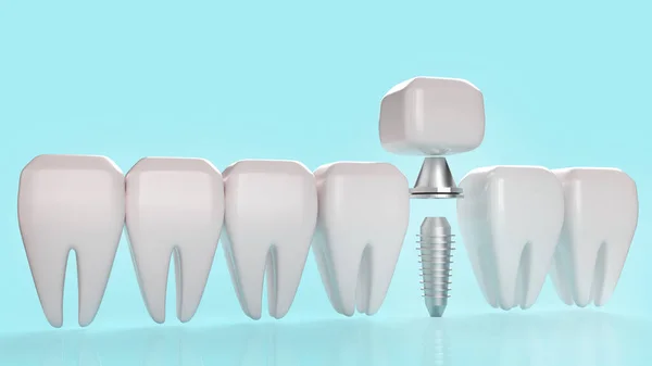 Imagem Renderização Implante Dentário Para Conteúdo Médico — Fotografia de Stock