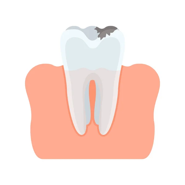 Diente lesionado con caries — Vector de stock