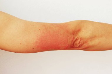 Elin derisinde kırmızı kabarcıklar ve vezikler foto dermatitin belirtileri olarak görülüyor. Güneş ışığına alerjik reaksiyon. Alerji.