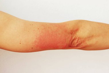 Red pustules and vesicles on the skin of the hand as symptoms of photodermatitis. Allergic reaction to sunlight. Allergy. clipart