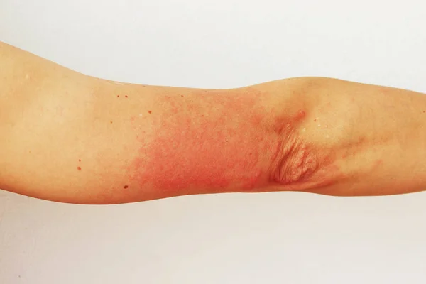 Elin derisinde kırmızı kabarcıklar ve vezikler foto dermatitin belirtileri olarak görülüyor. Güneş ışığına alerjik reaksiyon. Alerji.