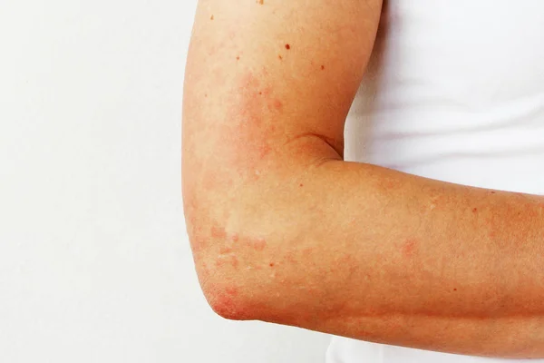 Pústulas Rojas Vesículas Piel Mano Como Síntomas Fotodermatitis Reacción Alérgica — Foto de Stock