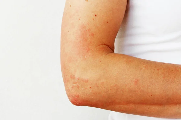 Elin derisinde kırmızı kabarcıklar ve vezikler foto dermatitin belirtileri olarak görülüyor. Güneş ışığına alerjik reaksiyon. Alerji.