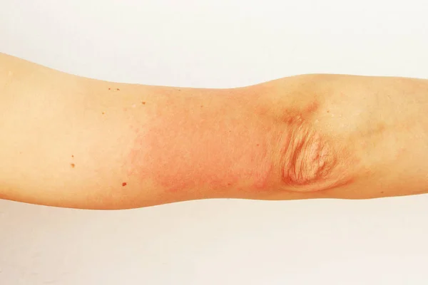 Pustole Rosse Vescicole Sulla Pelle Della Mano Come Sintomi Fotodermatite — Foto Stock