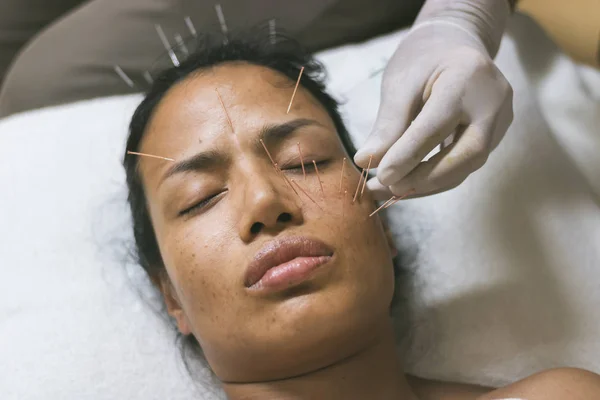 Asian women 40 years old acupuncture acupuncture on face to maintain health and skin to be healthy, firm skin.