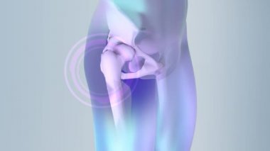 Kalça protezi implant leğen kemiği yüklü. Tıbben doğru 3d animasyon