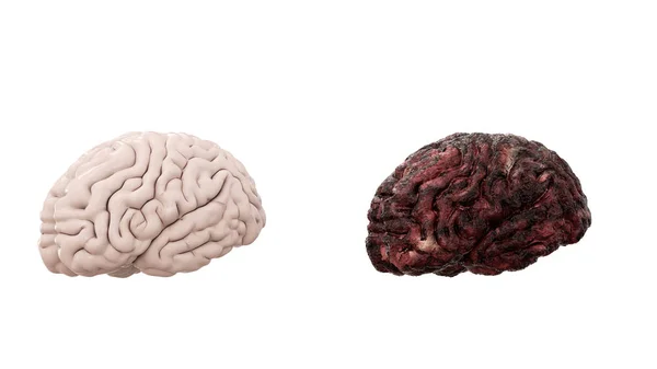 Friska hjärnan och sjukdomen hjärnan på vita isolat. Obduktionen medicinska begrepp. Cancer och rökning problem. — Stockfoto