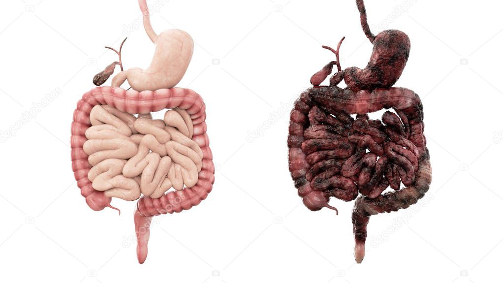 healthy intestines and disease intestines on white isolate. Autopsy medical concept. Cancer and smoking problem.