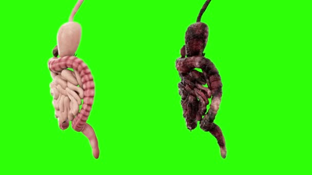 healthy intestines and disease intestines on green screen rotate. Autopsy medical concept. Cancer and smoking problem.