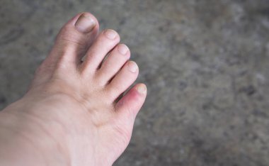 Kadın ayak üzerinde çürükler