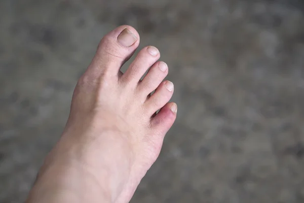 Moretones en el dedo del pie mujer — Foto de Stock