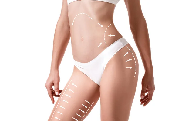 Женское тело со стрелками на рисунке изолировано на белом. Концепция удаления жира, липосакции и целлюлита . — стоковое фото