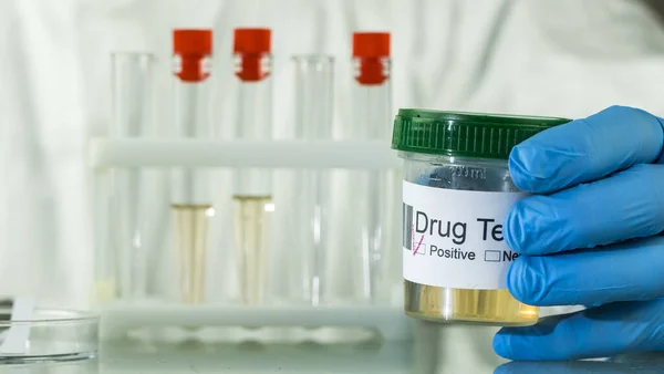 Mão na luva segura um frasco com análise de urina onde marcar um teste positivo para doping ou drogas — Fotografia de Stock