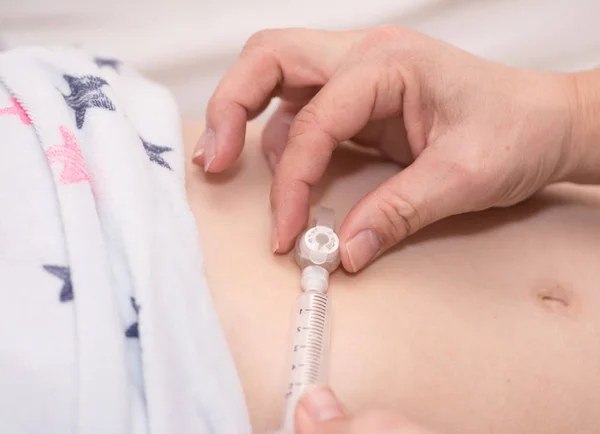 Um tubo de alimentação médica — Fotografia de Stock