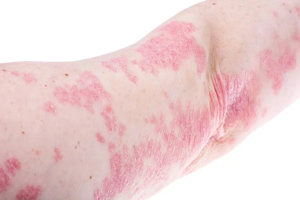 Dermatological skin disease psoriasis, more pronounced on elbow, hand. Redness and dry patches, allergic rash dermatitis, eczema of skin