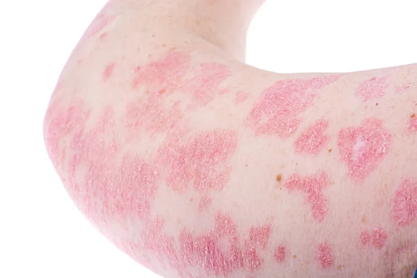 Doença dermatológica da pele psoríase, mais pronunciada no cotovelo, mão. Vermelhidão e manchas secas, erupção cutânea alérgica dermatite, eczema da pele — Fotografia de Stock