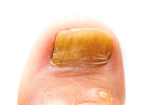 Fungus Infection on Nails — Stock Photo, Image