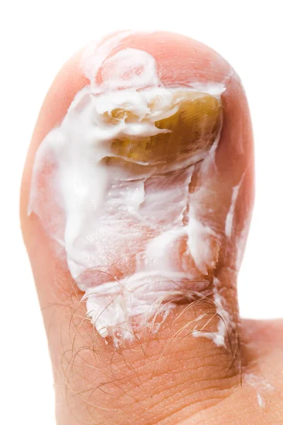 Schimmel infectie op nagels — Stockfoto