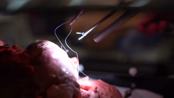 Хірург пришиває рану після операції — стокове відео