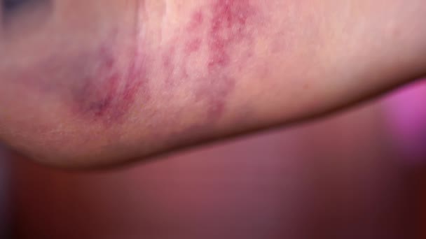 Close up a huge bruise on the arm — Stock Video