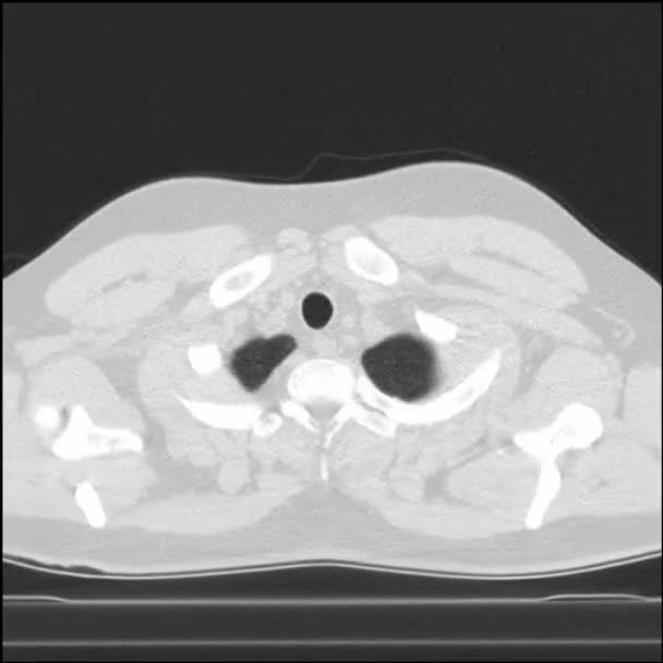 Skanning Bröstet Med Datortomografi Pulmonellt Läge — Stockvideo