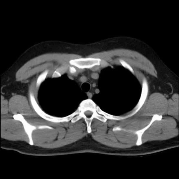 Skanning Bröstet Med Datortomografi Mediastinum Läge — Stockvideo