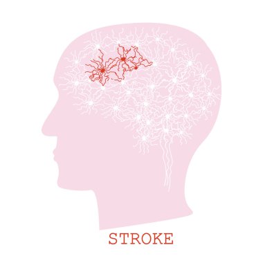 Stroke concept with human head silhouette clipart