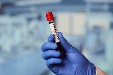 Laboratuvarda pozitif koronavirüs (COVID-19) kan testi yapan tek kullanımlık tıbbi eldiven giyen bir bulaşıcı hastalık hekiminin eli.