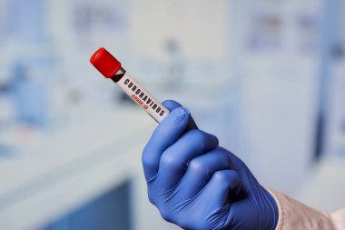 Laboratuvarda pozitif koronavirüs (COVID-19) kan testi yapan tek kullanımlık mavi eldivenli bir laboratuvar asistanının eli..