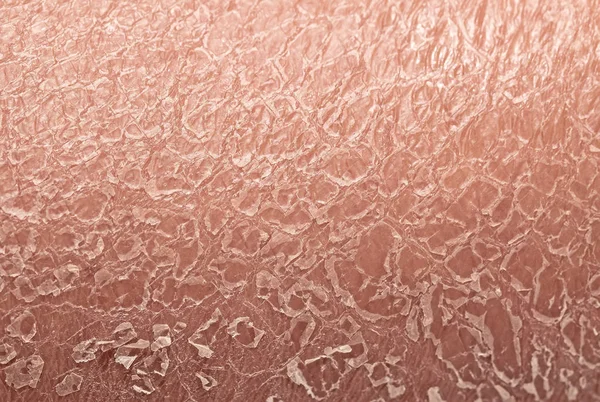 Кожа покрыта чешуей. Пластинчатый ламеллярный ихтиоз. Пластинчатый ламеллярный ихтиоз. Пластинчатый ламеллярный ихтиоз. Кератинопатический ихтиоз.