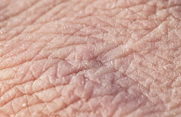 texture chapped pink of human skin with deep wrinkles and dry flakes