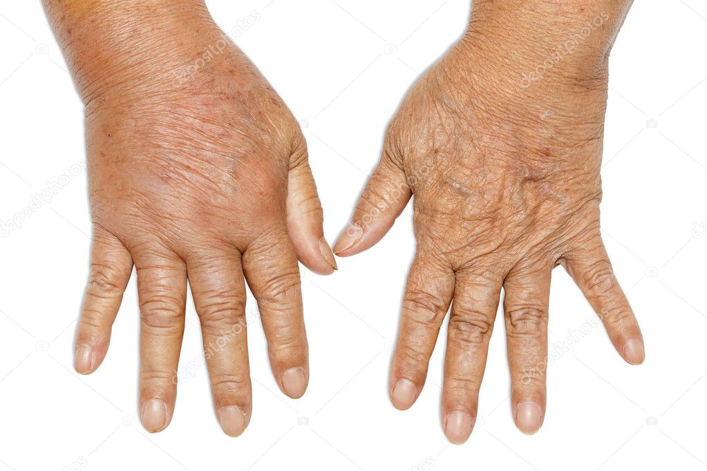 Hands swollen from diabetes Stock Photo by ©karnstocks 126707416
