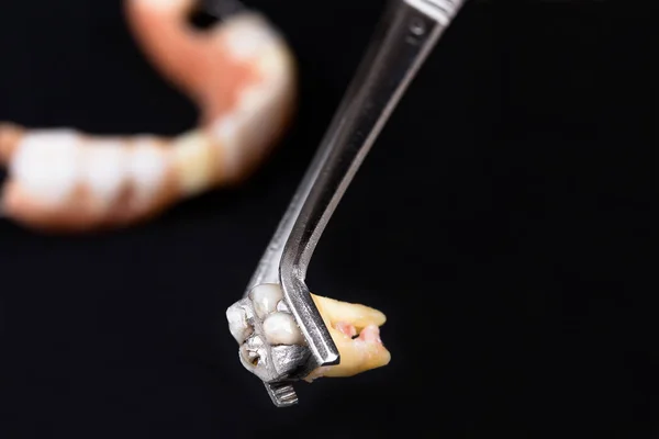 Den tand som tagits bort i tången — Stockfoto