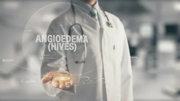Médico sosteniendo en la mano Angioedema Urticaria — Foto de Stock