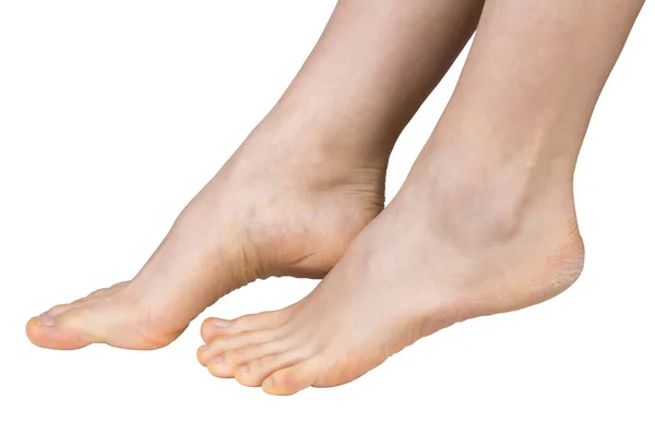 裸露的女性腿 有问题的 干枯的足部皮肤 与白色的背纹隔离 — 图库照片