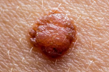 İnsan derisinde papilloma köstebeği, makro iğne, sağlık, cilt bakımı ve kanser riski kavramı