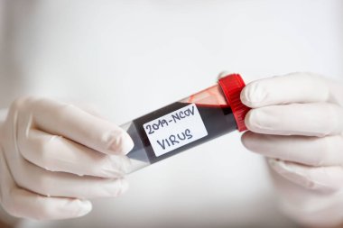 Doctor, laborant holding ampoule of blood with potential koronavirus infection