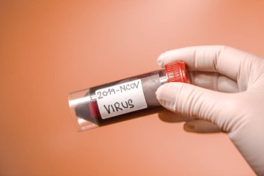 Doctor, laborant holding ampoule of blood with potential koronavirus infection