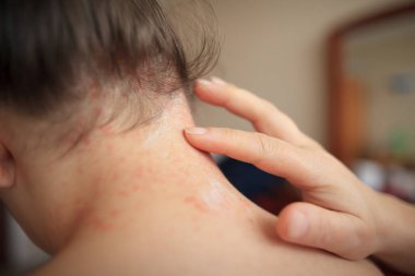 Kadın elleri, iyileşen merhem ve sağlık sigortası konseptiyle boynundaki hasarlı deriyi yağlar.