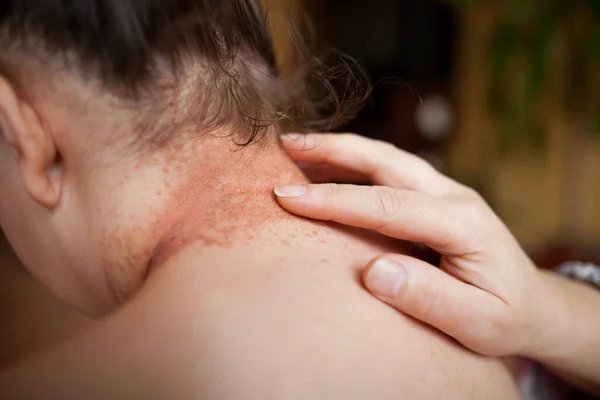 As mãos da mulher lubrificam a pele danificada nas costas pela pomada de cura, conceito de cuidados de saúde — Fotografia de Stock