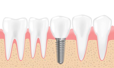 Sağlıklı dişler ve diş implantı. Diş tıbbi diş hekimliği gerçekçi vektör Illustration. İnsan dişleri diş implantasyon.