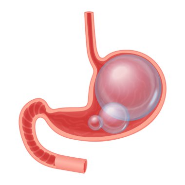 Realistic medical illustration of Abdominal bloated stomach isolated. Transperant ball inside stomach. clipart